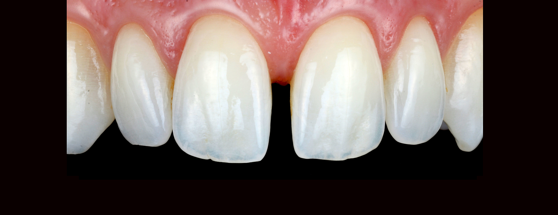 INVISIBLE RESTORATIONS – THIS IS HOW IT'S DONE